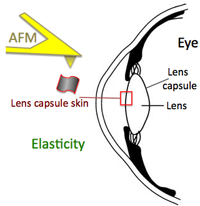 cataract